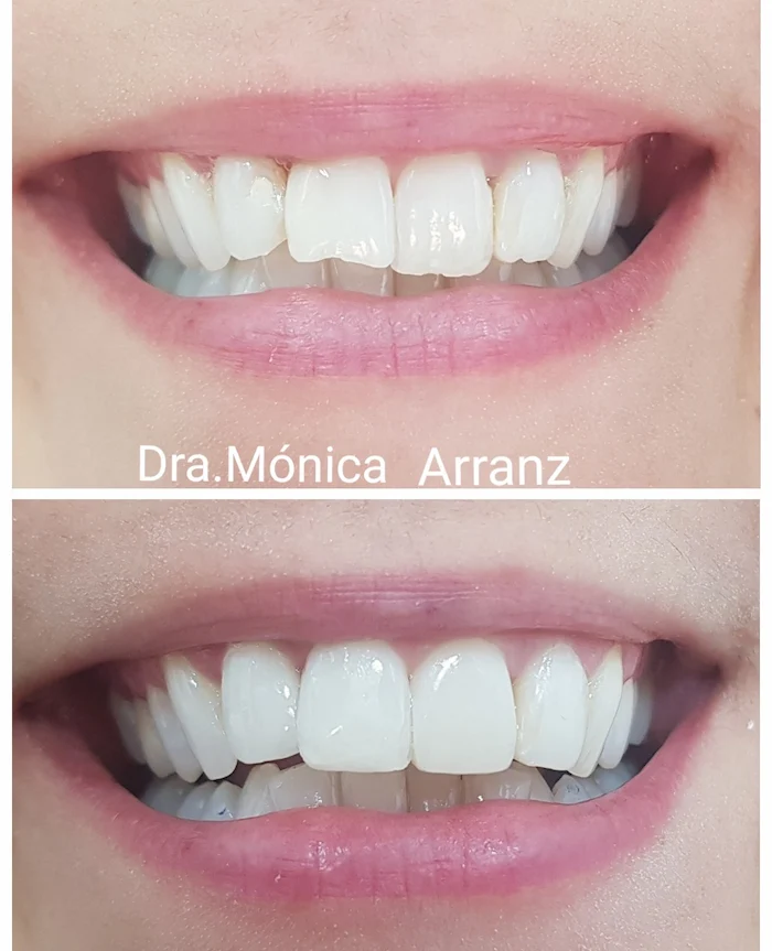 casos dentales estética dental