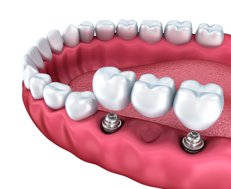 Implante Protesis dentales en el Centro Odontólogico y Estética Dental