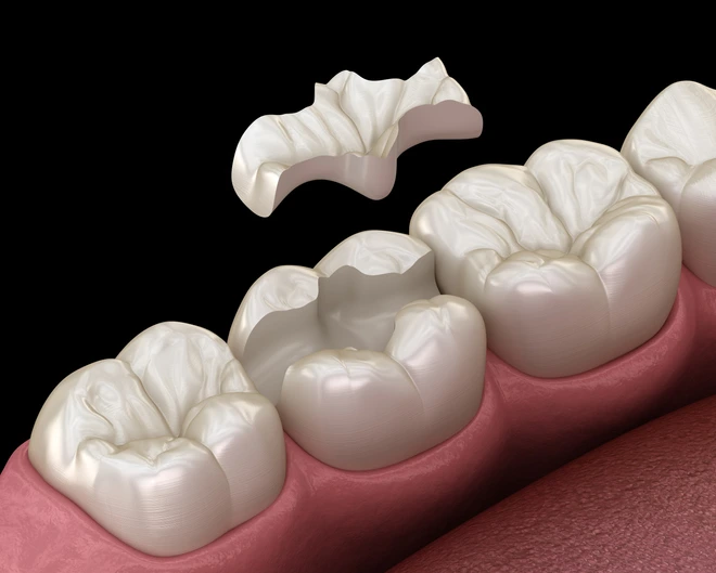 incrustaciones dentales en Tres Cantos