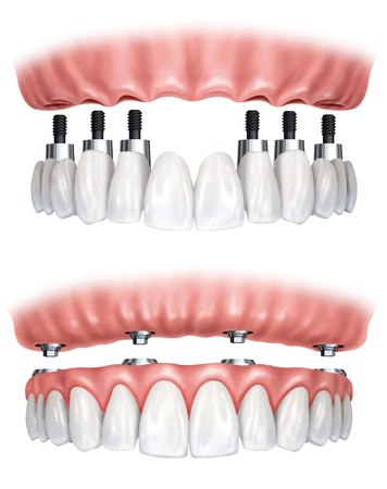 Protesis dentales en el Centro Odontólogico y Estética Dental